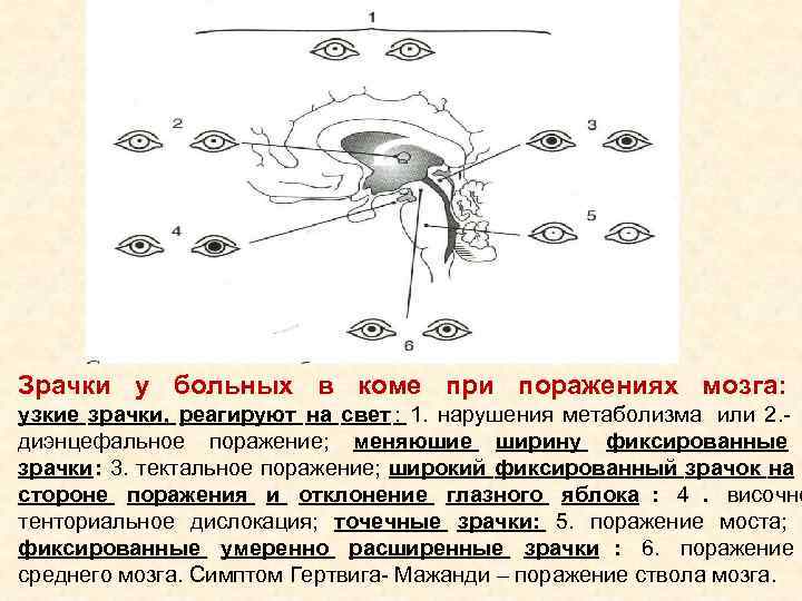 Зрачки у больных в коме при поражениях мозга: узкие зрачки, реагируют на Зрачки у больных в коме при поражениях мозга: узкие зрачки, реагируют на