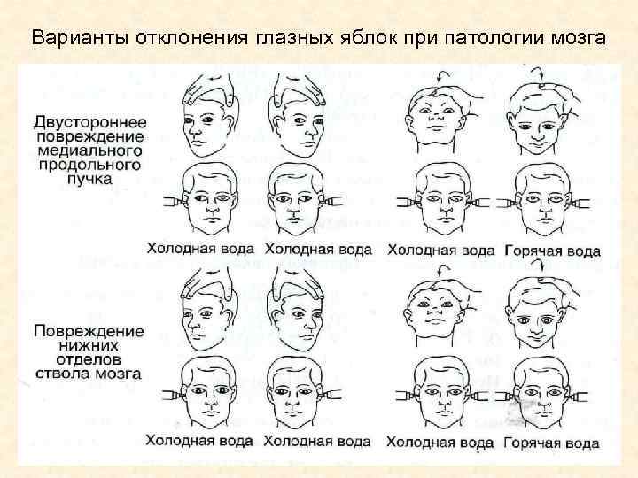 Варианты отклонения глазных яблок при патологии мозга Варианты отклонения глазных яблок при патологии мозга