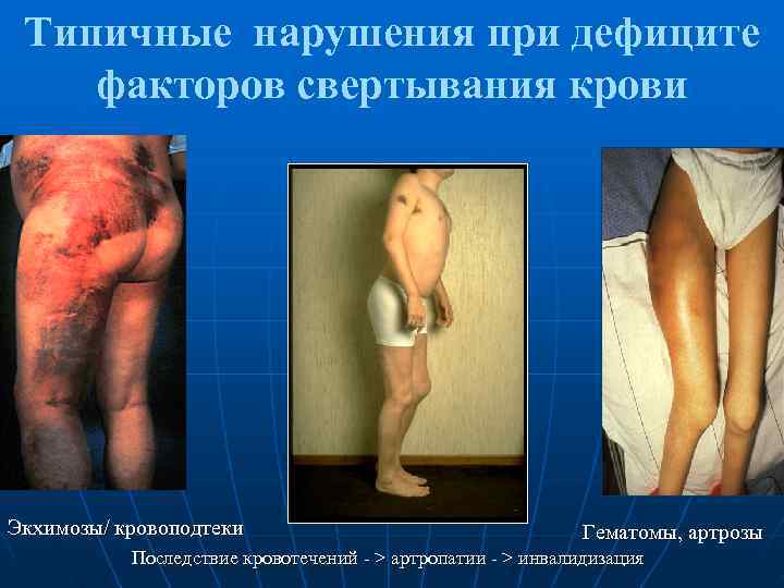  Типичные нарушения при дефиците факторов свертывания крови Экхимозы/ кровоподтеки    Гематомы,
