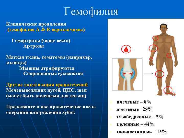      Гемофилия Клинические проявления (гемофилия А & B неразличимы) 
