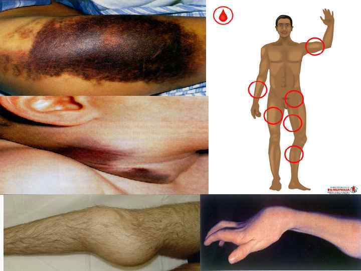  Мышечные кровоизлияния  после травм  спонтанные 