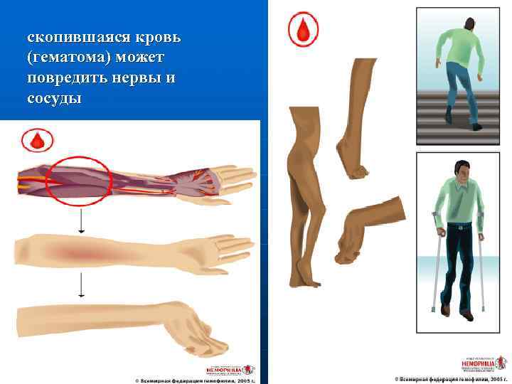 скопившаяся кровь (гематома) может повредить нервы и сосуды 