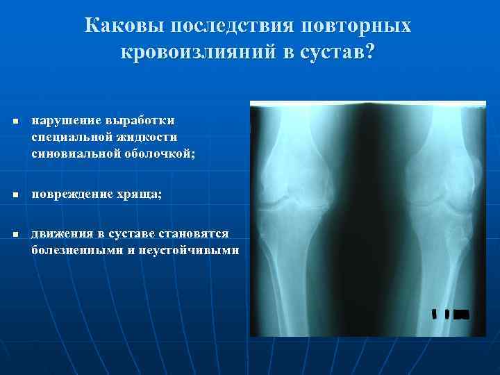  Каковы последствия повторных    кровоизлияний в сустав?  n 