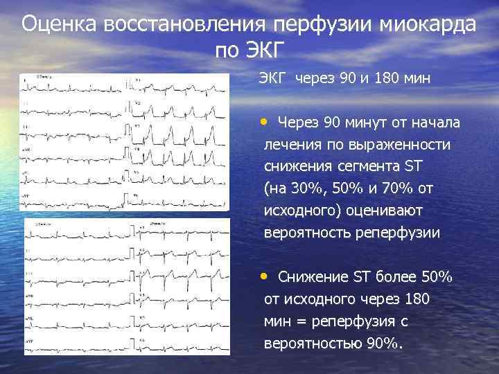 Оценка восстановления перфузии миокарда    по ЭКГ     ЭКГ