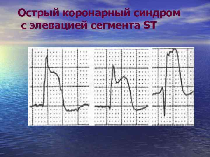 Острый коронарный синдром с элевацией сегмента ST 