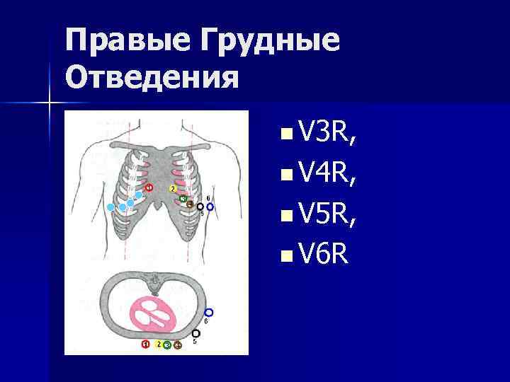 Правые Грудные Отведения  n V 3 R,   n V 4 R,