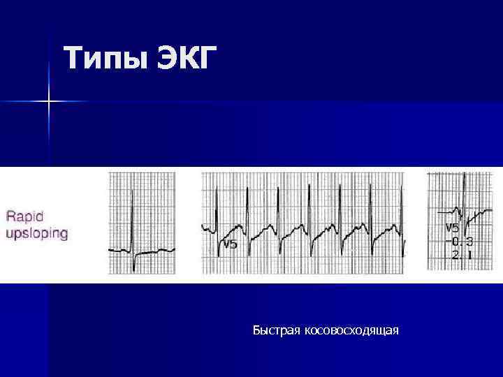 Типы ЭКГ    Быстрая косовосходящая 