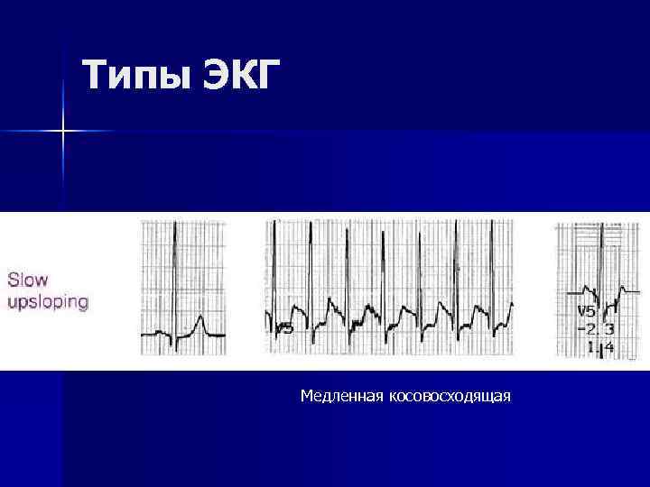 Типы ЭКГ    Медленная косовосходящая 