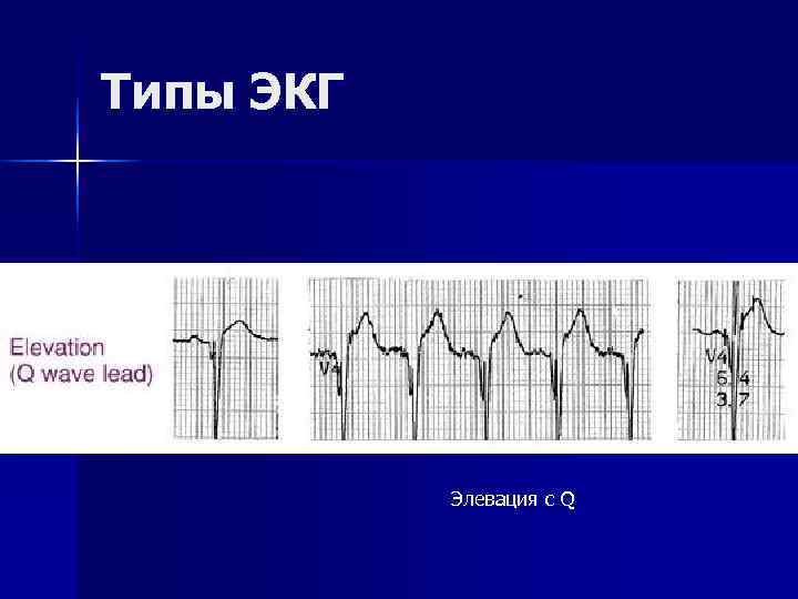 Типы ЭКГ    Элевация с Q 