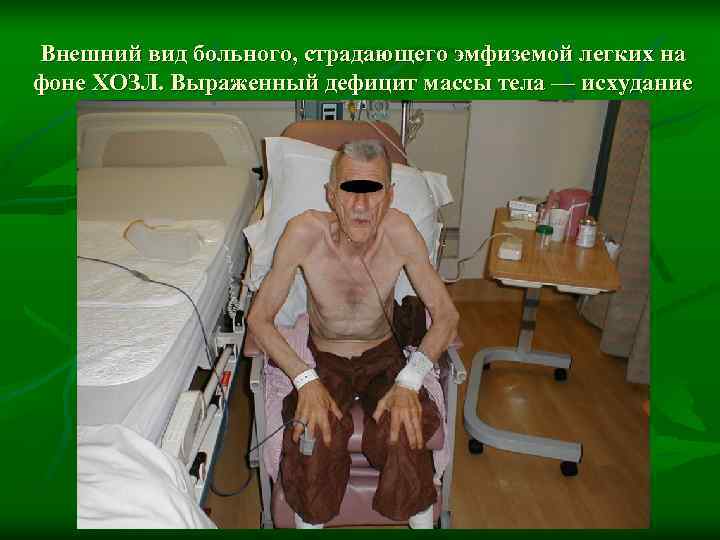 Внешний вид больного, страдающего эмфиземой легких на фоне ХОЗЛ. Выраженный дефицит массы тела —