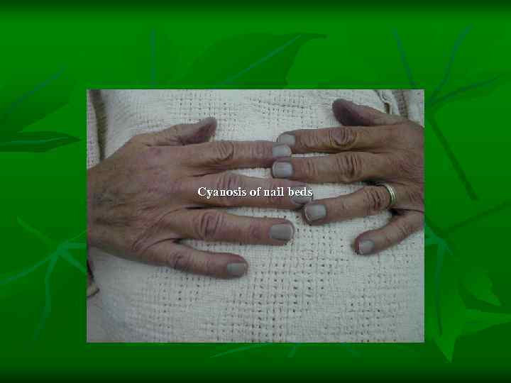 Cyanosis of nail beds 