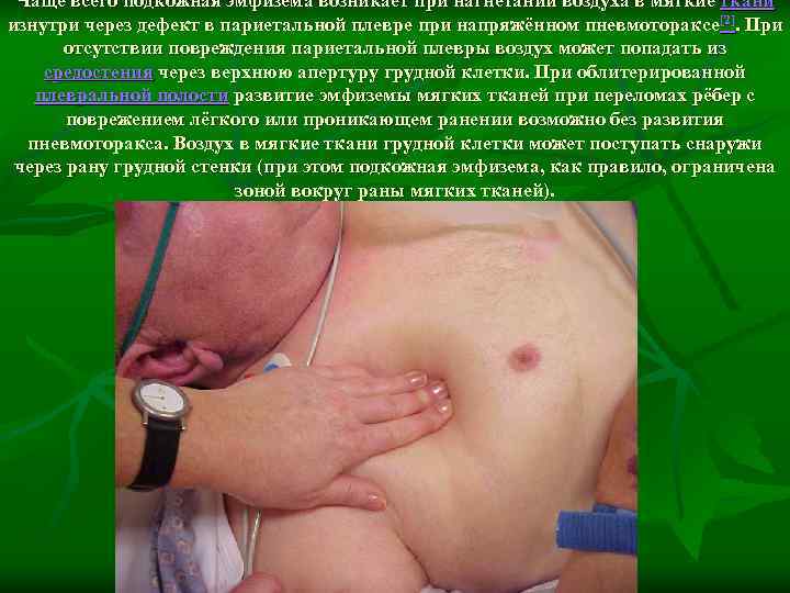  Чаще всего подкожная эмфизема возникает при нагнетании воздуха в мягкие ткани изнутри через