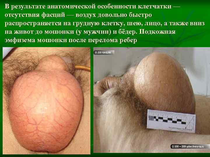 В результате анатомической особенности клетчатки — отсутствия фасций — воздух довольно быстро распространяется на