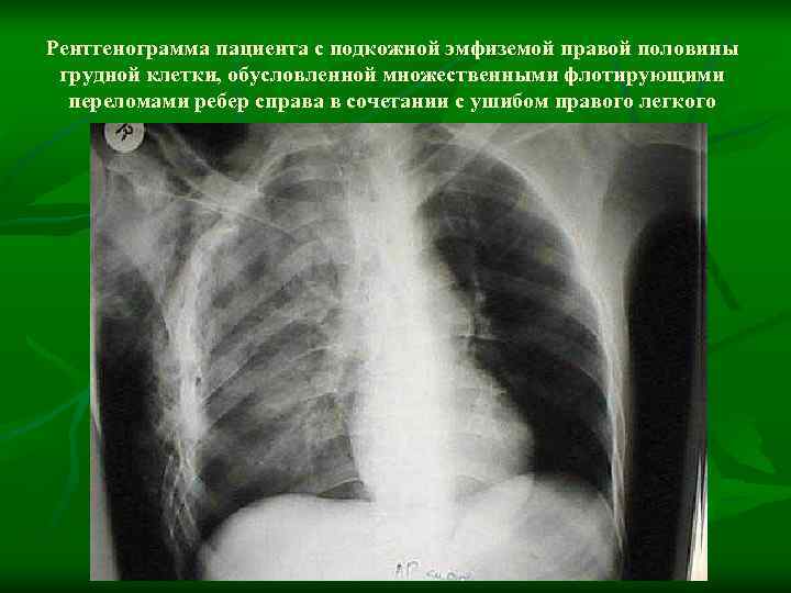 Рентгенограмма пациента с подкожной эмфиземой правой половины  грудной клетки, обусловленной множественными флотирующими 