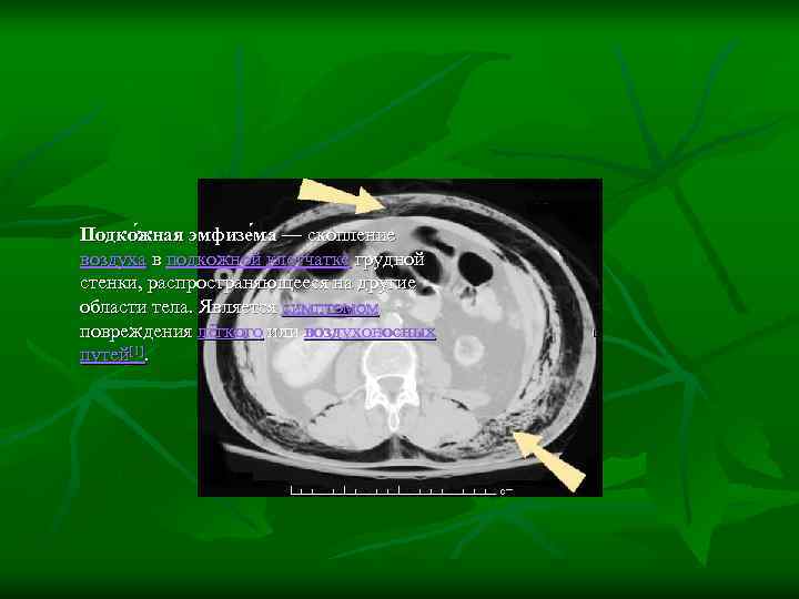 Подко жная эмфизе ма — скопление воздуха в подкожной клетчатке грудной стенки, распространяющееся на