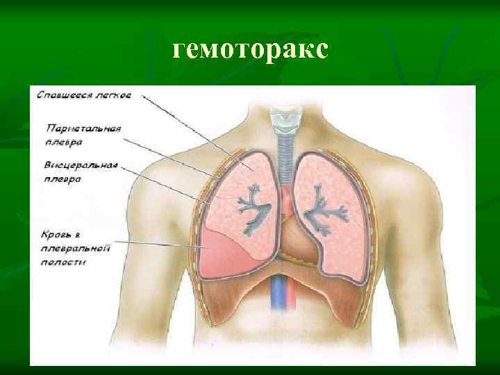 гемоторакс 