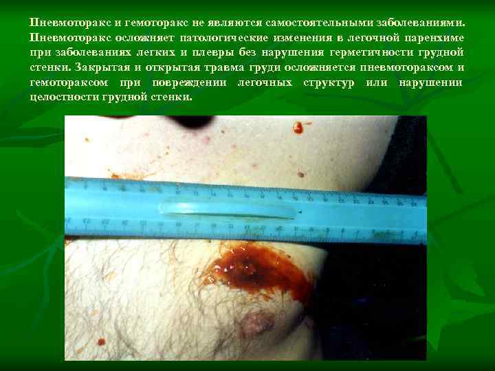 Пневмоторакс и гемоторакс не являются самостоятельными заболеваниями.  Пневмоторакс осложняет патологические изменения в легочной