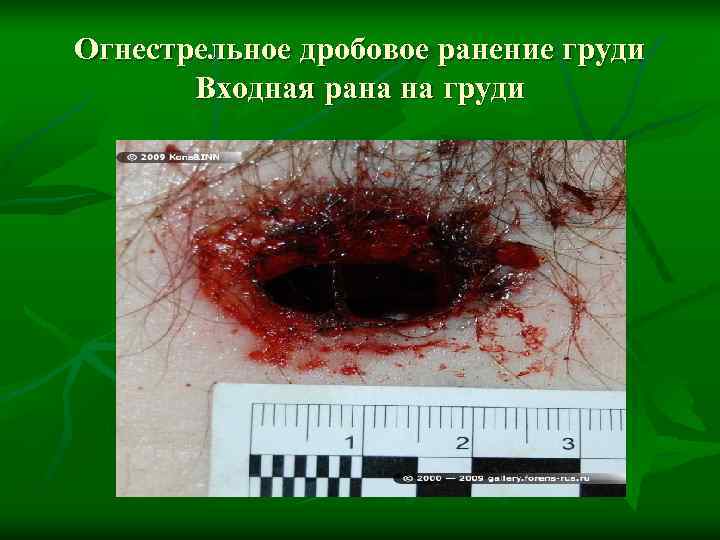 Огнестрельное дробовое ранение груди  Входная рана на груди 