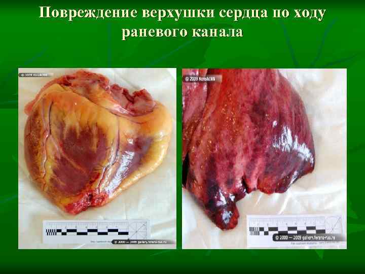 Повреждение верхушки сердца по ходу  раневого канала 