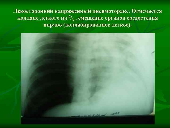 На рентгенологической картине напряженного пиопневмоторакса отмечается смещение средостения в