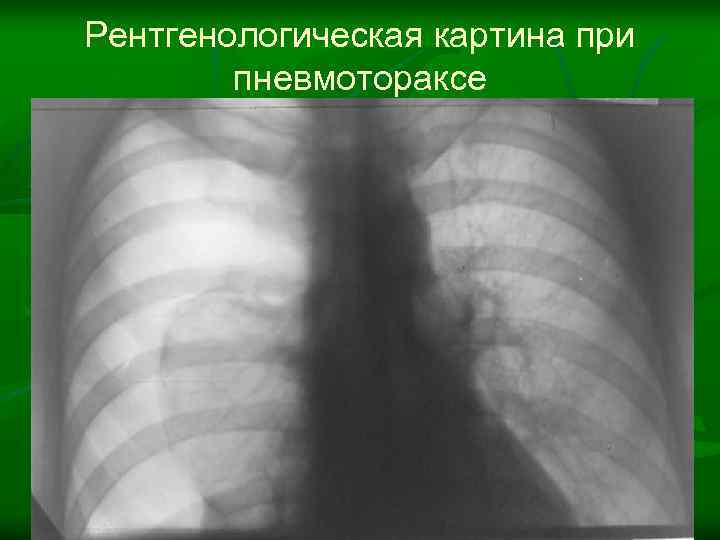 Рентгенологическая картина при   пневмотораксе 