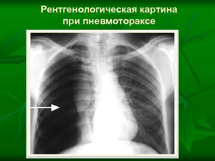 Рентгенологическая картина при пневмотораксе 