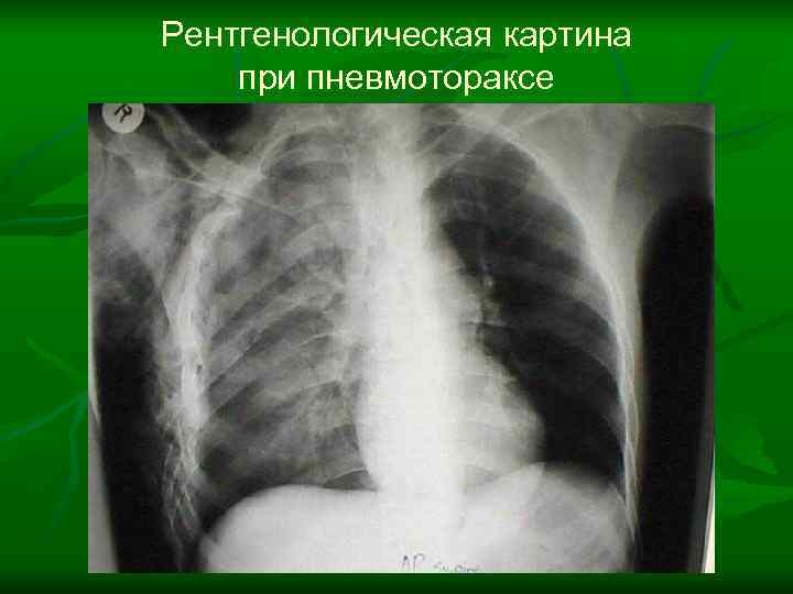 Рентгенологическая картина при пневмотораксе 