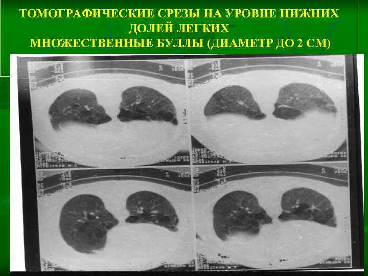 ТОМОГРАФИЧЕСКИЕ СРЕЗЫ НА УРОВНЕ НИЖНИХ    ДОЛЕЙ ЛЕГКИХ  МНОЖЕСТВЕННЫЕ БУЛЛЫ (ДИАМЕТР