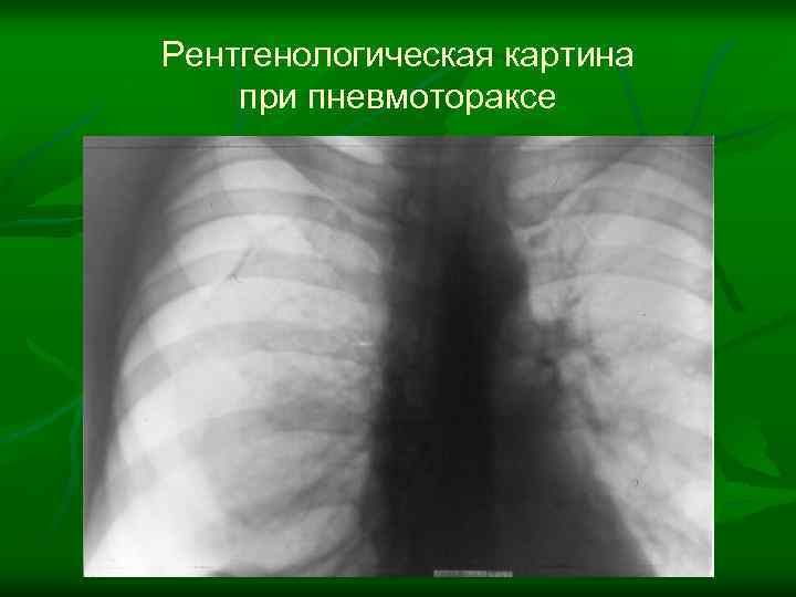 Рентгенологическая картина при пневмотораксе 