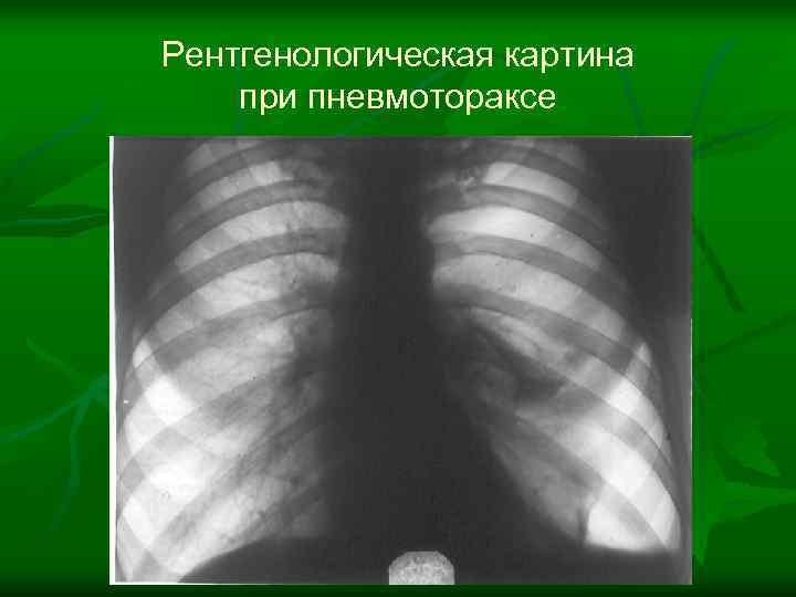 Рентгенологическая картина при пневмотораксе 