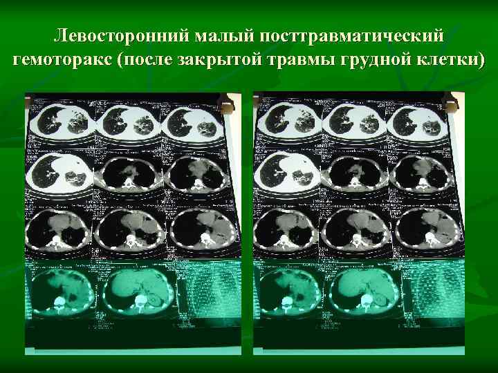   Левосторонний малый посттравматический гемоторакс (после закрытой травмы грудной клетки) 