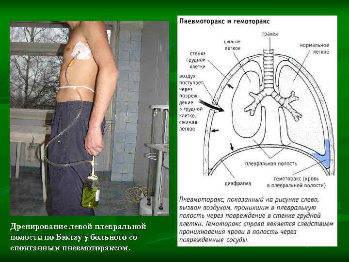 Дренирование левой плевральной полости по Бюлау у больного со спонтанным пневмотораксом. 