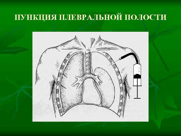 Плевральная пункция рисунок