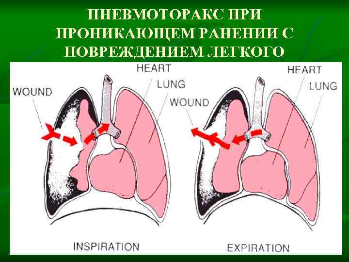   ПНЕВМОТОРАКС ПРИ ПРОНИКАЮЩЕМ РАНЕНИИ С  ПОВРЕЖДЕНИЕМ ЛЕГКОГО 