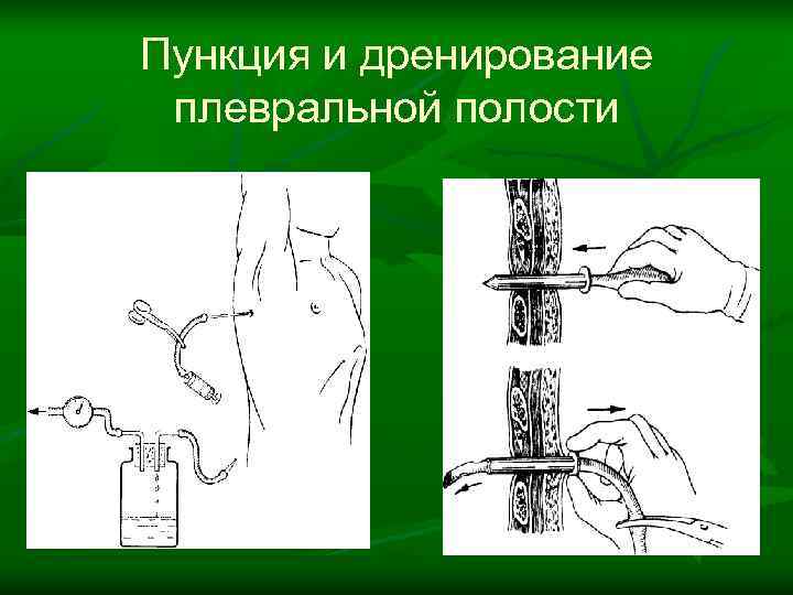 Пункция и дренирование плевральной полости 