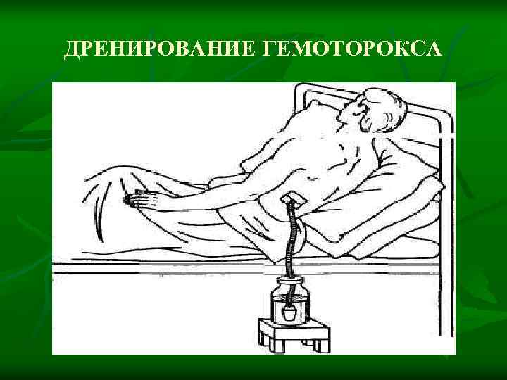 ДРЕНИРОВАНИЕ ГЕМОТОРОКСА 