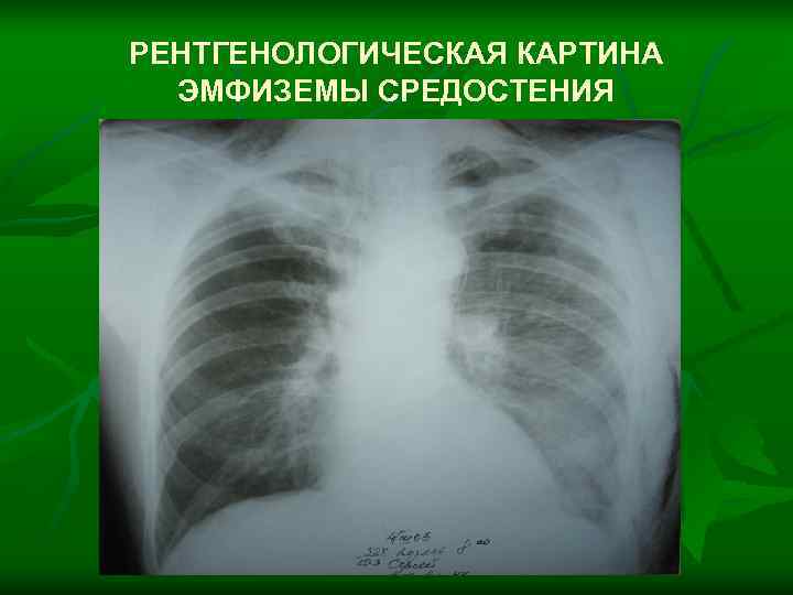 РЕНТГЕНОЛОГИЧЕСКАЯ КАРТИНА  ЭМФИЗЕМЫ СРЕДОСТЕНИЯ 