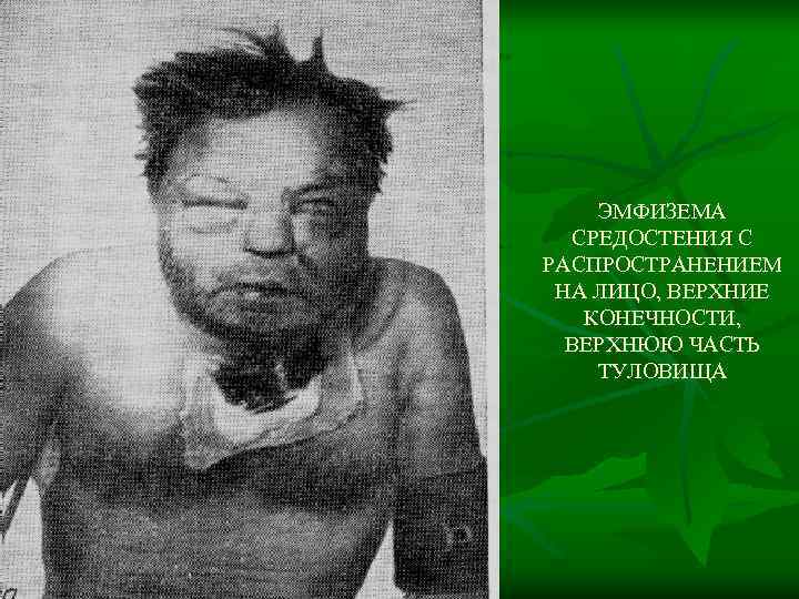   ЭМФИЗЕМА  СРЕДОСТЕНИЯ С РАСПРОСТРАНЕНИЕМ  НА ЛИЦО, ВЕРХНИЕ КОНЕЧНОСТИ, ВЕРХНЮЮ ЧАСТЬ