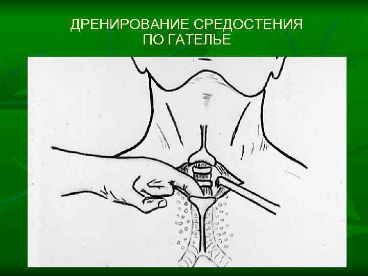 ДРЕНИРОВАНИЕ СРЕДОСТЕНИЯ  ПО ГАТЕЛЬЕ 