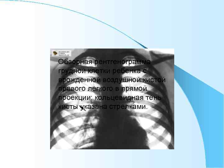 Обзорная рентгенограмма грудной клетки ребенка с врожденной воздушной кистой правого легкого в прямой проекции: