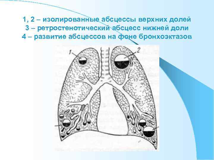 1, 2 – изолированные абсцессы верхних долей 3 – ретростенотический абсцесс нижней доли 4