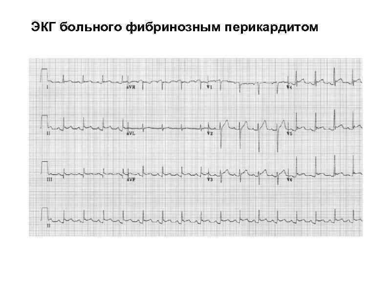 Перикардит экг картина