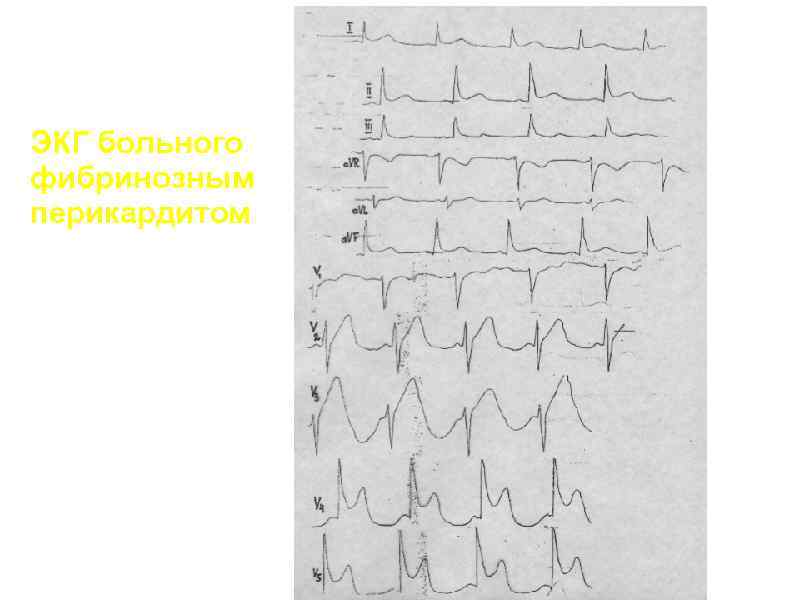 Перикардит экг картина