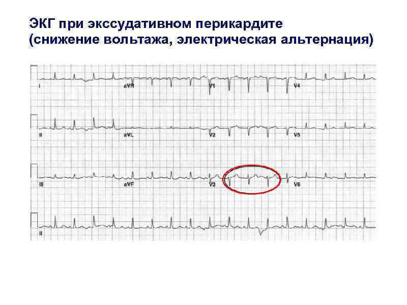 Вольтаж экг