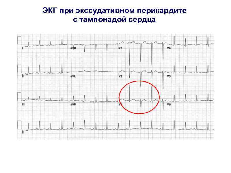 Перикардит экг картина