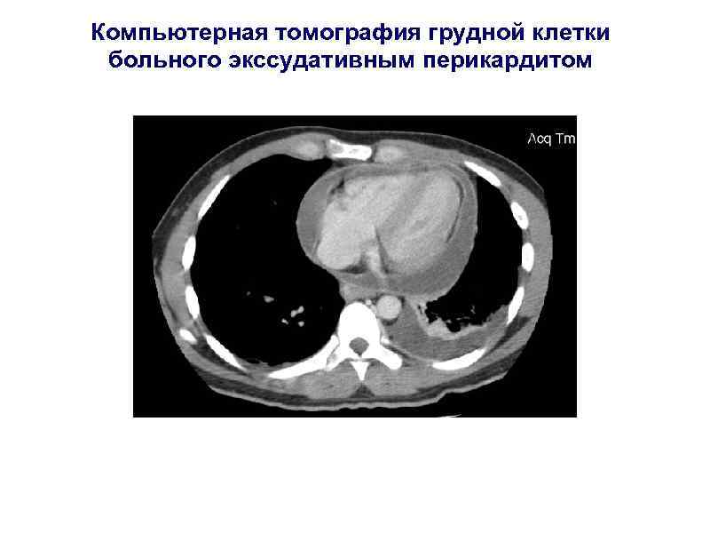 Компьютерная томография грудной клетки больного экссудативным перикардитом 