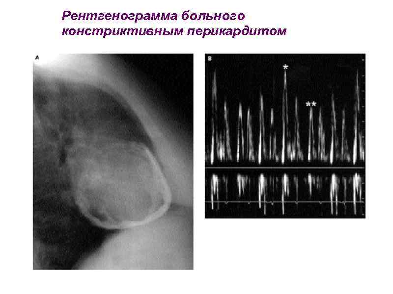 Рентгенограмма больного констриктивным перикардитом 