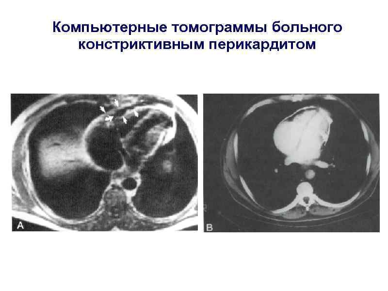Компьютерные томограммы больного  констриктивным перикардитом 