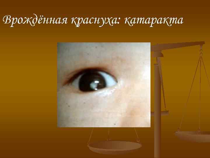 Врождённая краснуха: катаракта Врождённая краснуха: катаракта