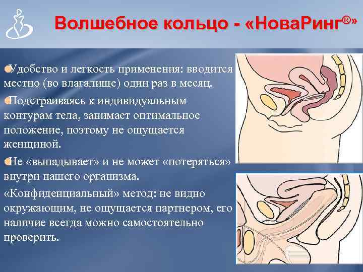    Волшебное кольцо - «Нова. Ринг®»  Удобство и легкость применения: вводится